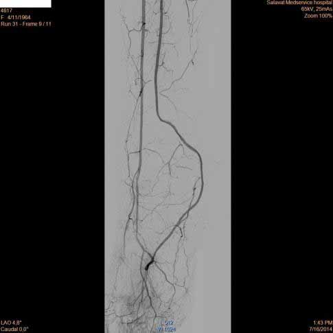 Атеросклероз артерий нижних конечностей. Лечение
